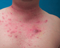 Chest with visible acne lesions