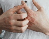 Hands with dry, itchy skin showing signs of irritation