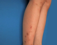 Pigmented acne scars on legs