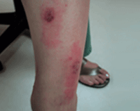 Thigh skin affected by eczema, showing redness, inflammation, and irritation